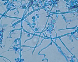 Trichophyton indotineae Abb. 4 a